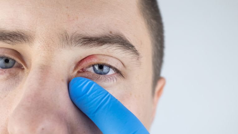 Photo d'un homme aux yeux bleus avec une blépharite sur le dessus de la paupière gauche. Un tiers de la paupière apparaît gonflée et rouge. Un doigt ganté pointe vers cette zone.