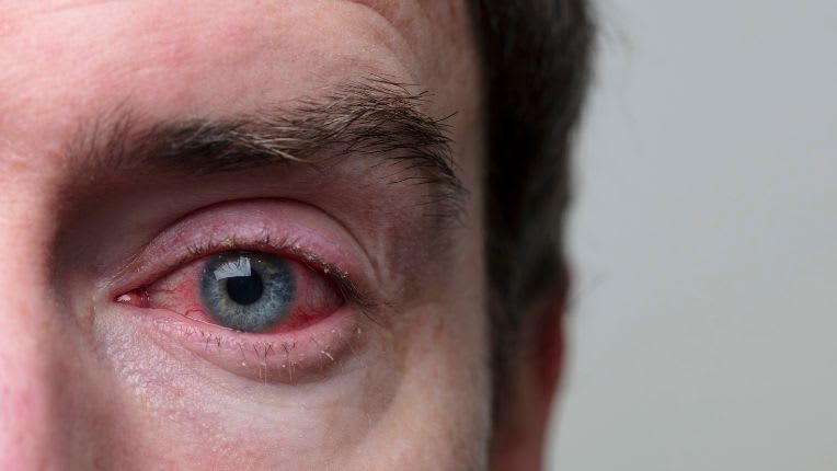 Photo d'un œil larmoyant et très rouge typique d'une blépharite.