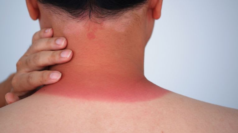 Le soleil est-il la seule cause du cancer de la peau ? Image d'un coup de soleil magistral dans le cou, rouge, tandis que la peau est blanche ailleurs.