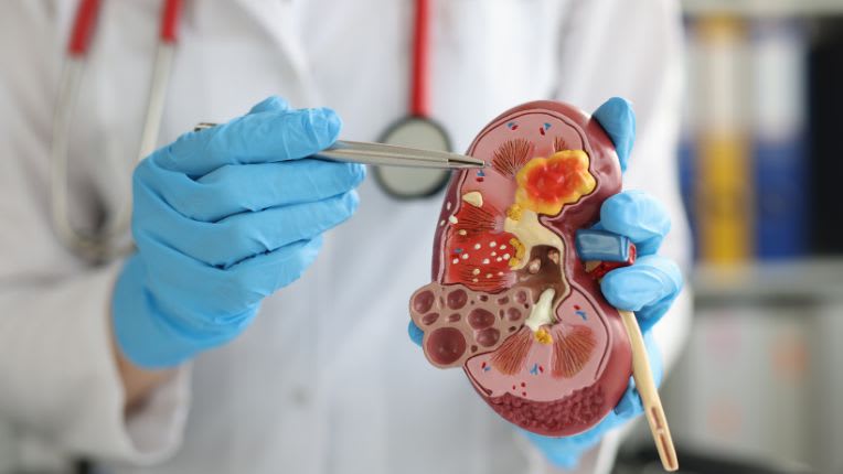 Cancer du rein : un soignant illustre ce sujet en utilisant un modèle en plastique de la coupe d'un rein.