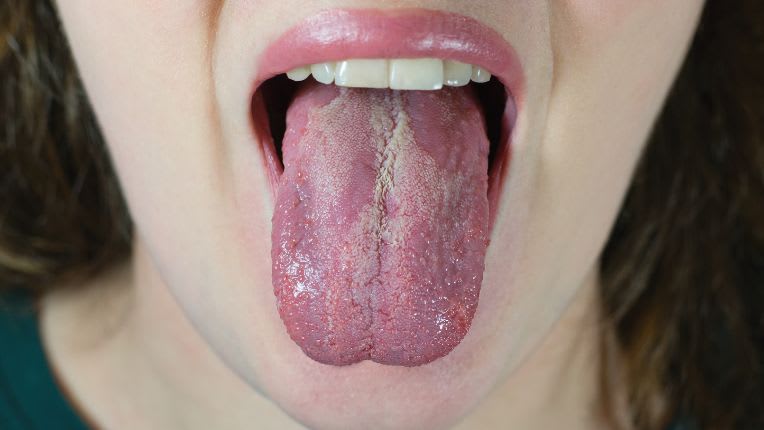 Candidose buccale (langue blanche) : photo d'une jeune fille tirant la langue avec des traces de blanc dessus comme du lait caillé.
