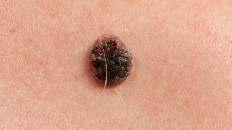 Quels sont les différents types de cancer de la peau ? Image d'un carcinome épidermoïde à l'aspect granuleux et marron foncé.