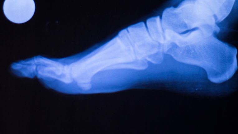 Où se faire opérer du pied à Lyon quand on vient de l'étranger ? Radiographie d'un pied.