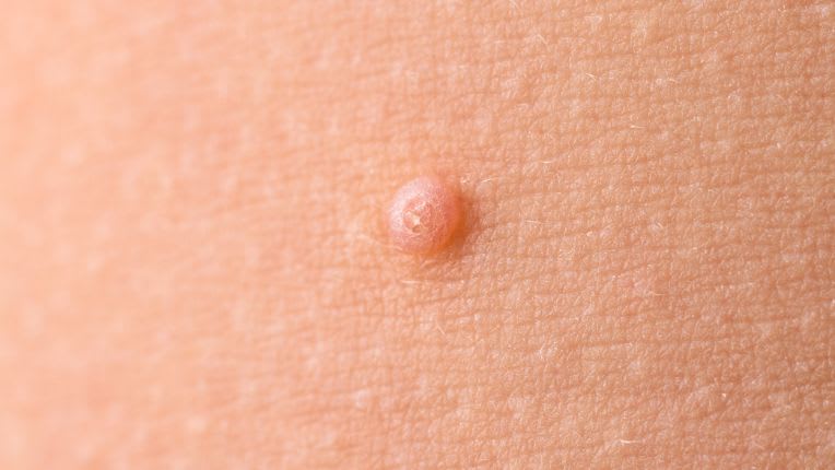 Comment savoir si un nodule est cancéreux ? Image d'un nodule sur la peau.