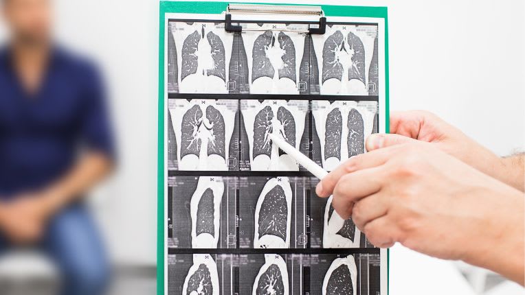Un dépistage généralisé du cancer du poumon à l’étude. Un pneumologue examine les images des poumons d'un patient souffrant d'une fibrose, obtenues par scanner.