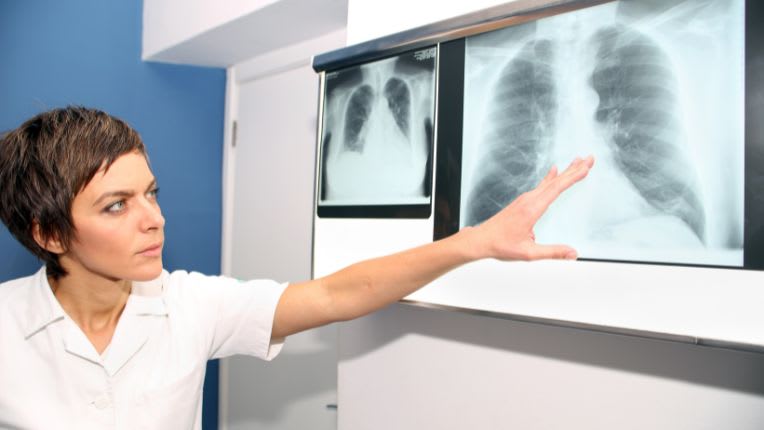 Embolie pulmonaire : définition, causes et traitements. Une médecin examine des clichés de poumons pris au scanner.
