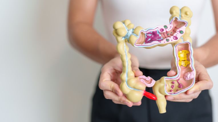 Est-ce que les femmes sont touchées par le cancer du côlon ? Photo d'une femme qui tient un modèle anatomique réduit de côlon dans les mains.