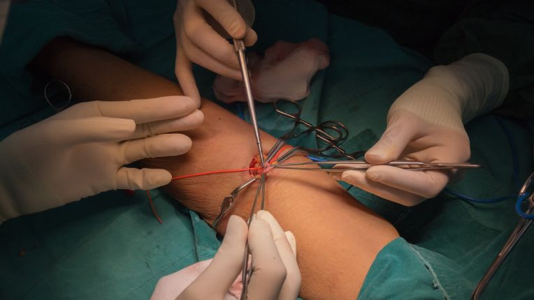 Image de chirurgiens en train de créer une fistule artério-veineuse dans le bras.