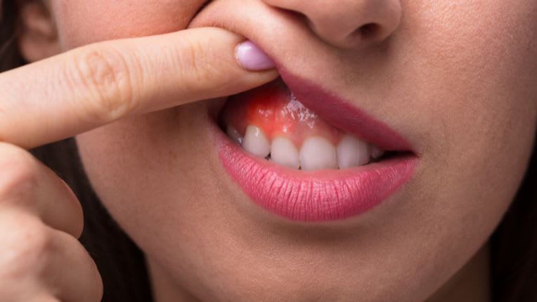 Femme ouvrant la bouche sur une gencive rouge. Une gencive gonflée et rouge peut indiquer une inflammation aiguë.