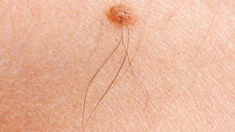 Grain de beauté et cancer : comment savoir si un grain de beauté est dangereux ? Mélanome. Grain de beauté irrégulier sur la peau bombé et de couleur beige pâle.