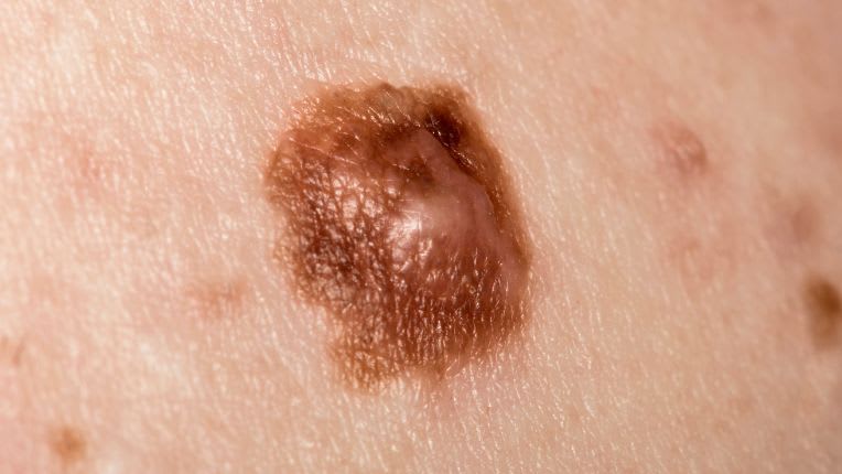 Grain de beauté et cancer : comment savoir si un grain de beauté est dangereux ? Mélanome. Grain de beauté irrégulier sur la peau bombé et de couleur beige pâle.
