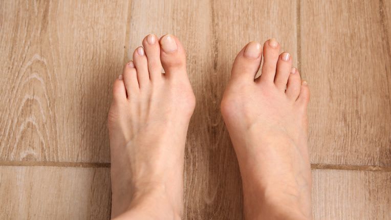 Hallux valgus bilatéral. Image de deux pieds de femme posés sur un parquet. On voit nettement la déformation des gros orteils et la présence d'oignons.