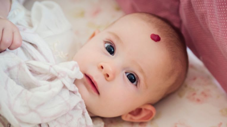 Photo d'un hémangiome infantile en forme de "fraise" sur le front d'un nourrisson.