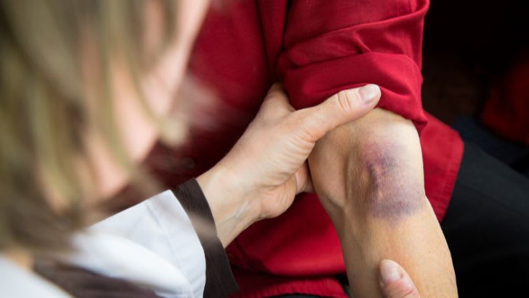 Hémorragie : une soignante examine un hématome dans le pli du bras d'un patient.