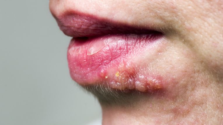 Image d'herpès labial.