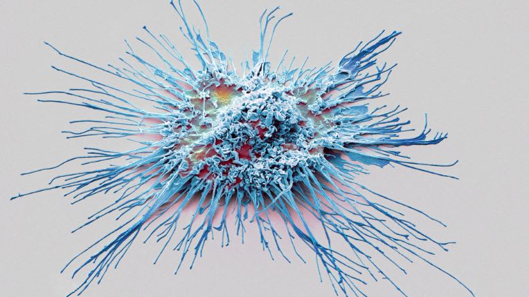 Histiocytose : image d'une cellule dendritique en couleur obtenue avec un micrographe électronique à balayage.