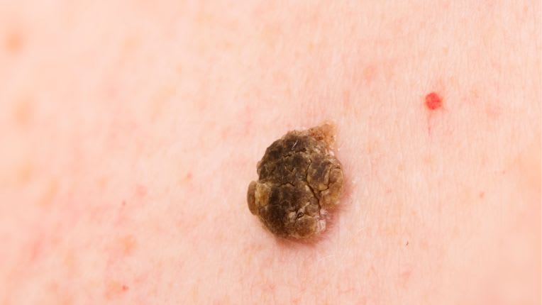 Vue de près d'une kératose séborrhéique : petite lésion de couleur brun clair à brun foncé, avec une apparence squameuse, agglomération de cellules mortes qui forment des excroissances.