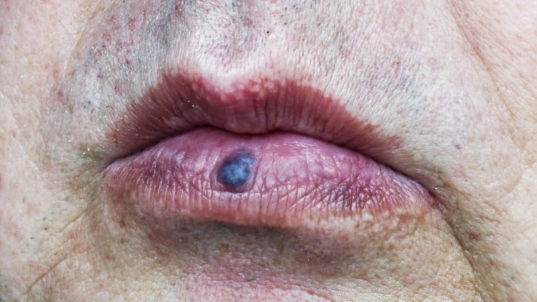Photo d'un lac veineux sur la lèvre inférieure chez un adulte âgé
