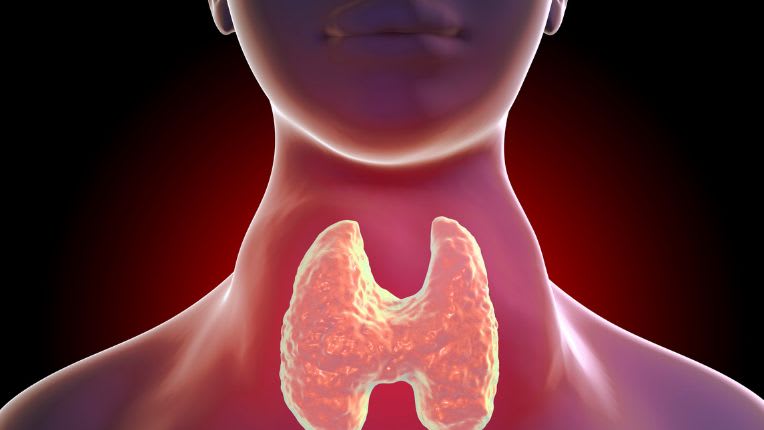 Levothyroxine (Levothyrox) : comment bien prendre ce traitement contre l'hypothyroïdie ? Image de synthèse figurant une personne avec un goitre (cou enflé) et la thyroïde en forme de papillon.