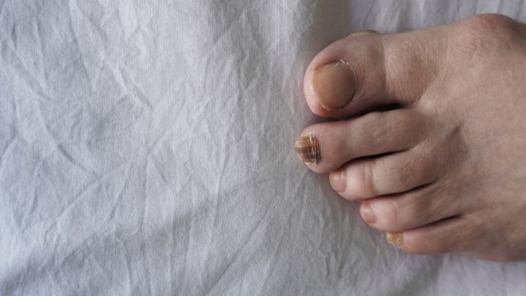Quels sont les différents types de cancer de la peau ? Image d'un pied dont les ongles sont atteint par le cancer. Ongles noirs et striés.