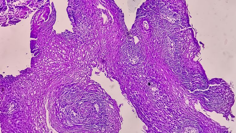 Opération de l’adénocarcinome par robot à Brest. Adénocarcinome vu au microscope.