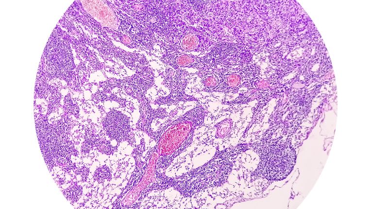 Opération de l’adénocarcinome par robot à Montauban. Image au microscope d'un adénocarcinome de l'estomac.