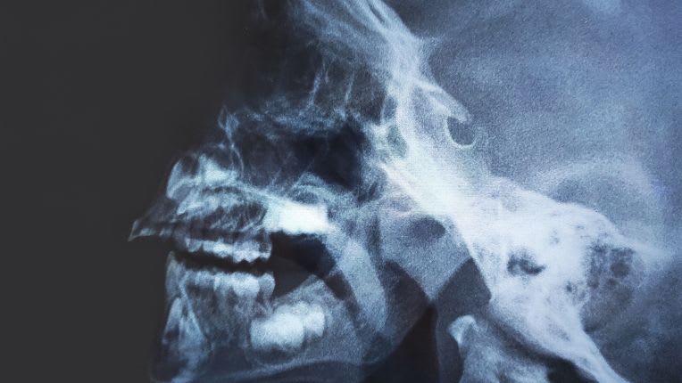 Opération du nasopharynx par robot à Brest. Image aux rayons X de la face dans le cadre d'une hypertrophie des végétations.