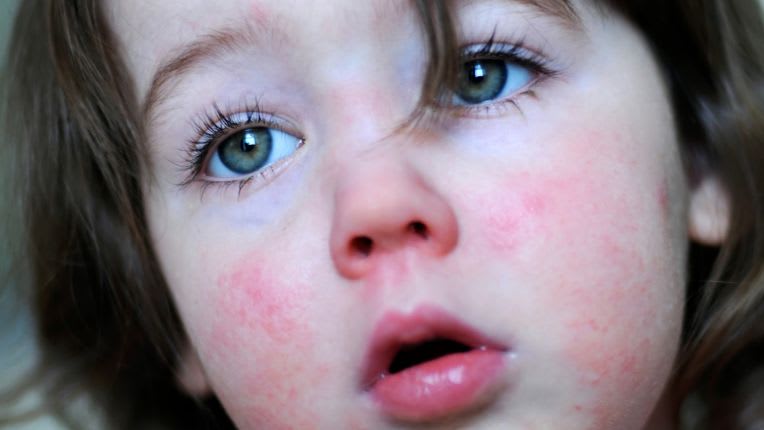 Scarlatine : image d'une petite fille aux joues rouges typiques d'une scarlatine.