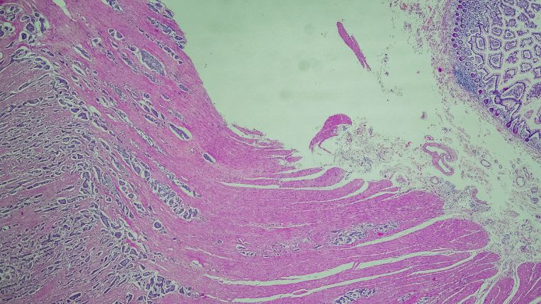 Tumeur neuroendocrine. Image au microscope d'une tumeur neuroendocrine bien différenciée.