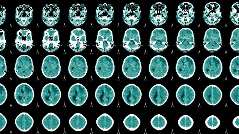 Vaccin méningite à méningocoques Marseille. Série d'images de scanner du cerveau d'un homme.