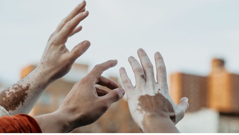 Vitiligo : mains avec des taches blanches élevées vers le ciel...