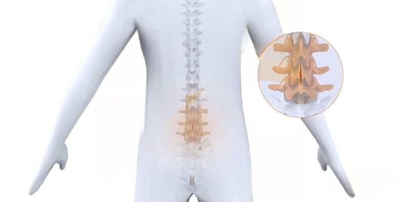 Chirurgie hernie discale lombaire