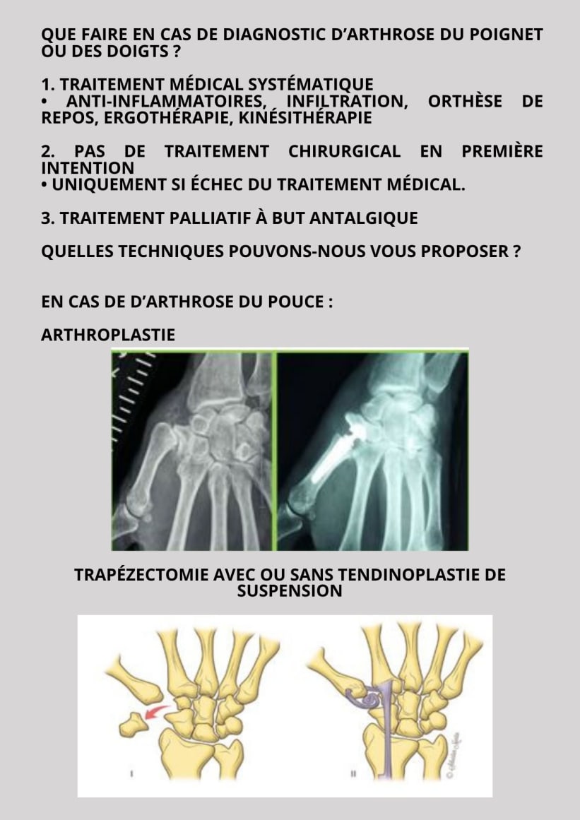 ARTHROSE DU POIGNET ET DES DOIGTS,  POSSIBILITÉS THÉRAPEUTIQUES