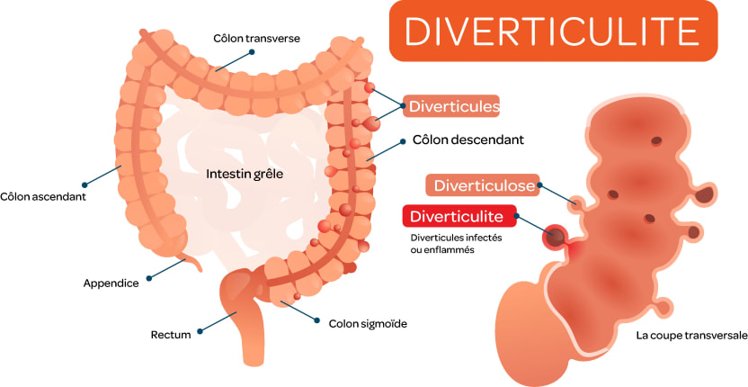 diverticulite schéma