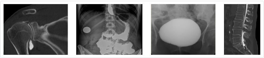 Clichés radiographie avec injection PDC