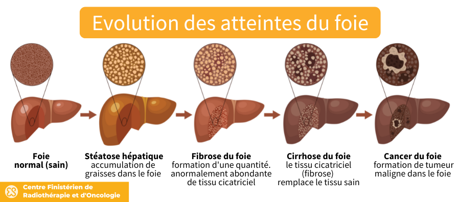 cancer du foie stade et esperance de vie
