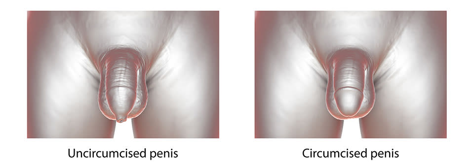 circoncision