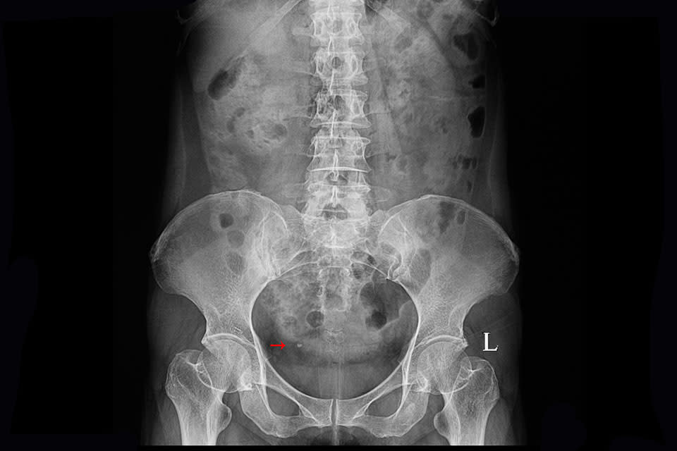 hematurie