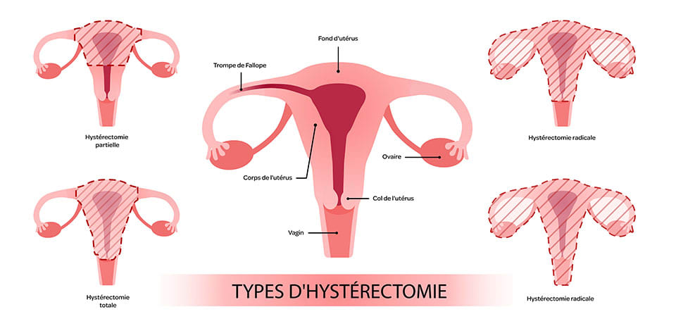 types d'hysterectomie