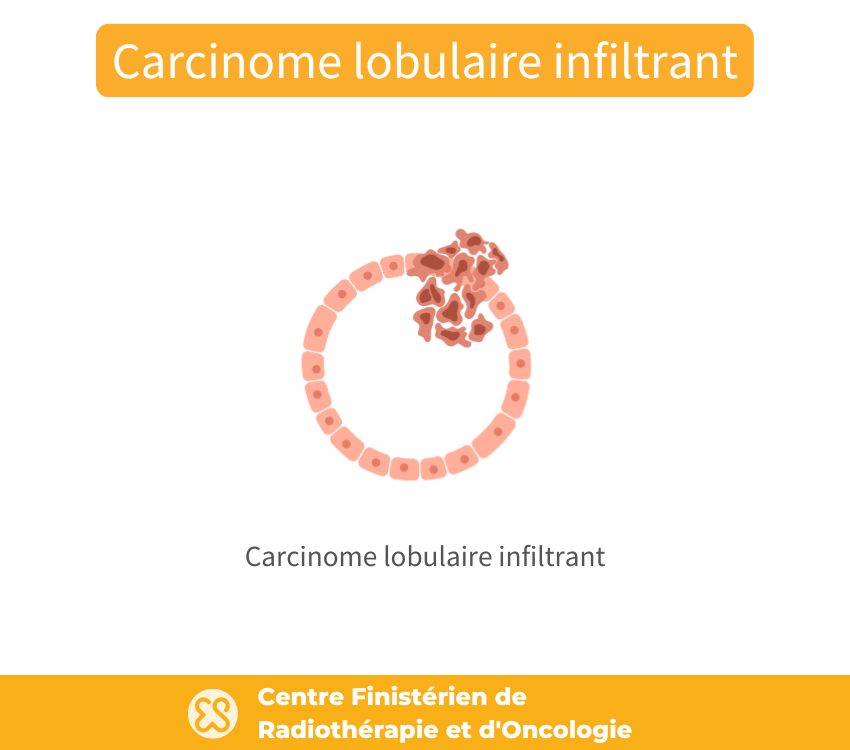 Carcinome lobulaire infiltrant sein