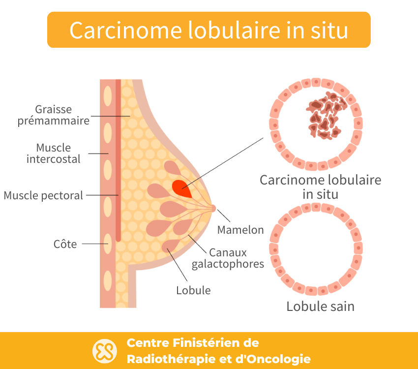 Carcinome lobulaire in situ