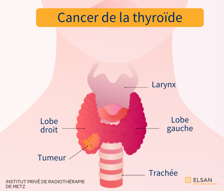 Cancer de la thyroïde