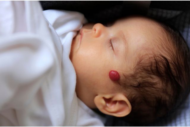 Hémangiome chez un nouveau-né qui prend la forme d'un gros bouton rouge sur le haut de sa joue.