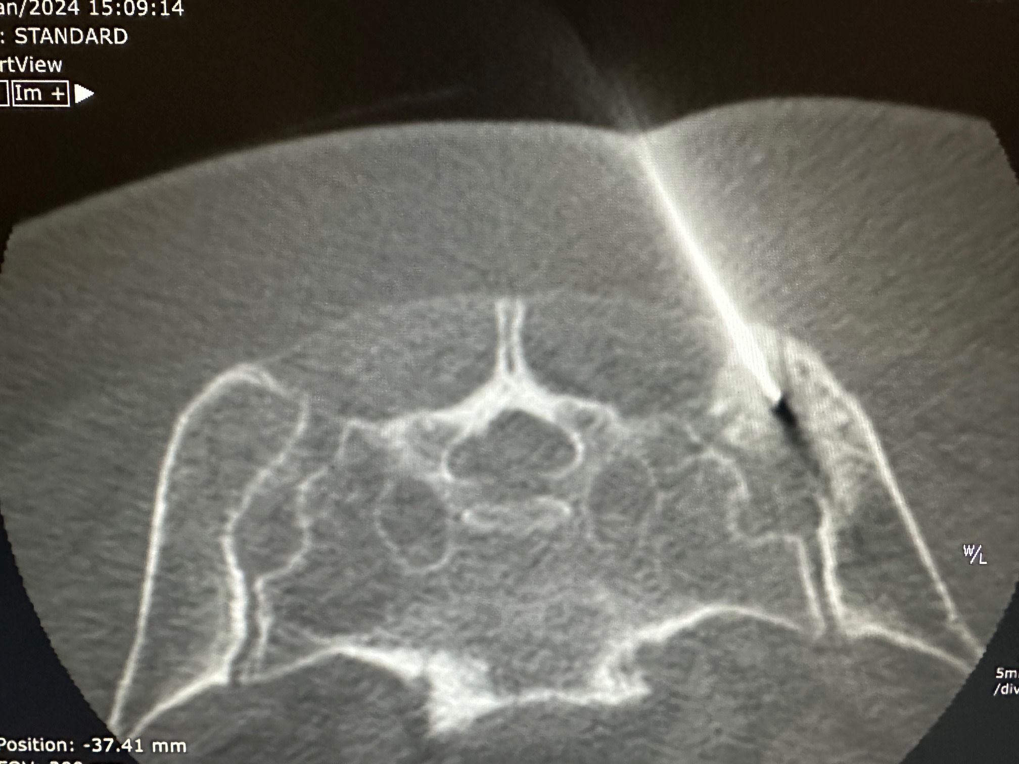 Sonde en place au niveau de la lésion osseuse