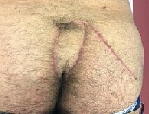 kyste pilonidal. Lambeau perforant : résultat à un mois