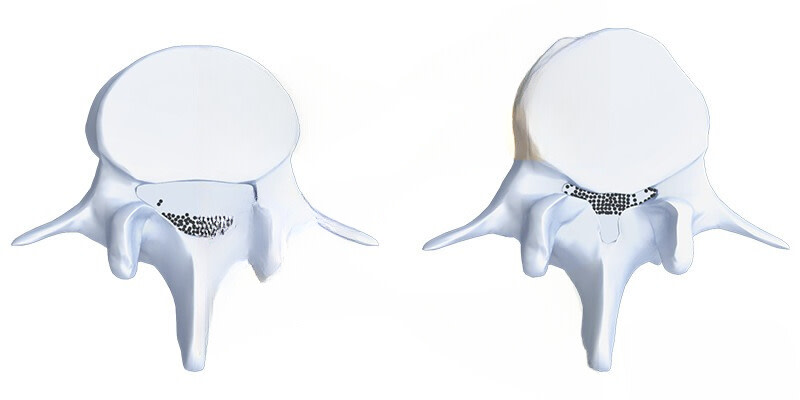 canal lombaire étroit