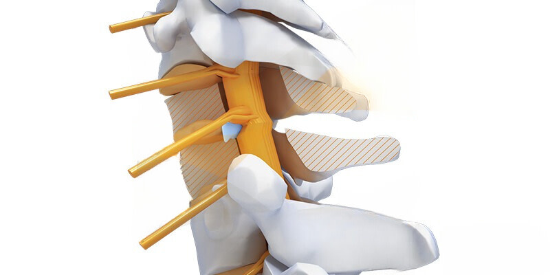 hernie discale cervicale