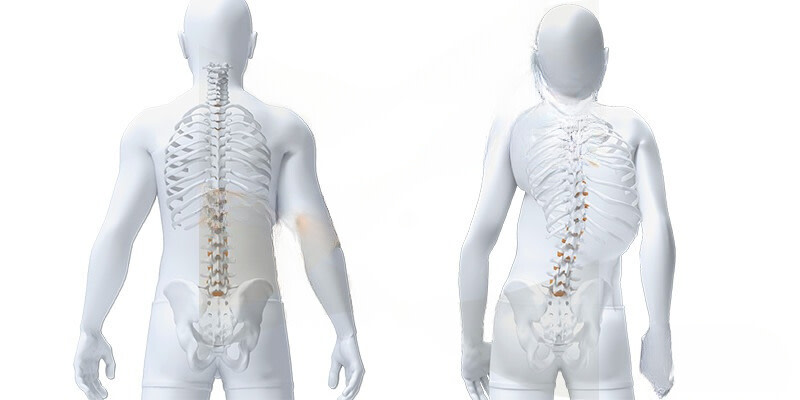 scoliose idiopathique adolescent