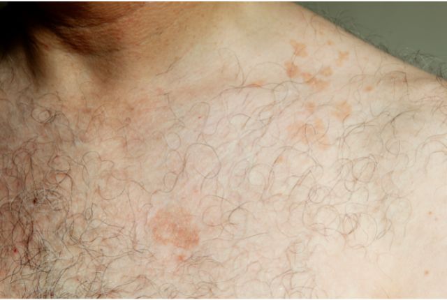 Pityriasis versicolor