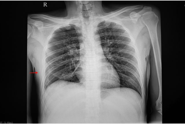 Pneumothorax